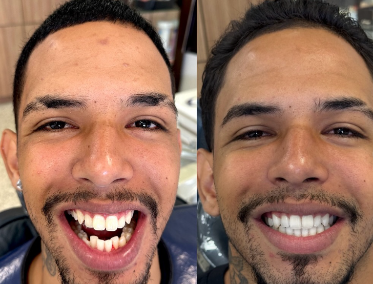 Antes e depois — procedimento 7