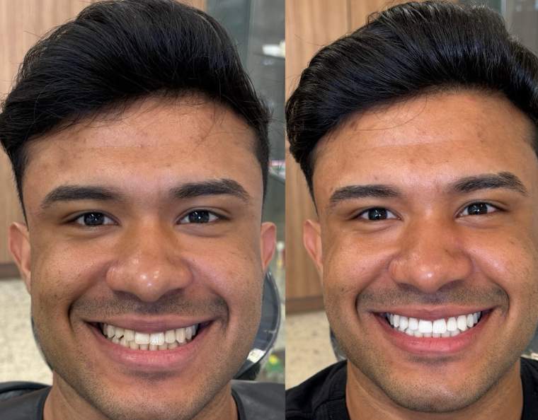 Antes e depois — procedimento 8