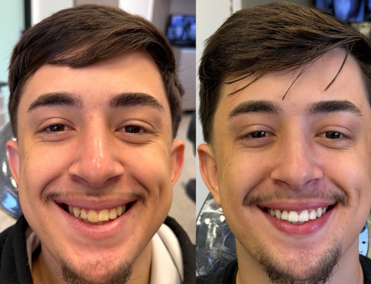 Antes e depois — procedimento 9
