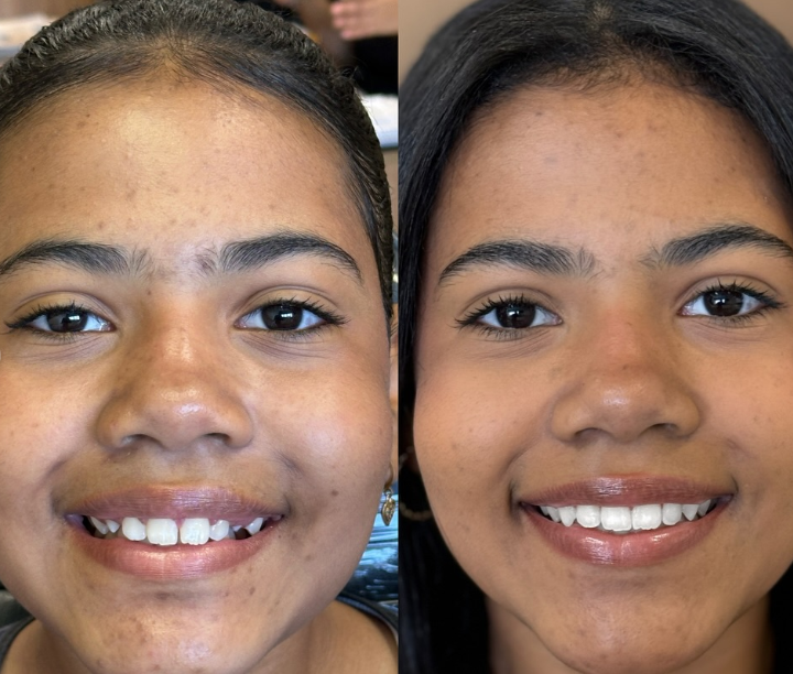 Antes e depois — procedimento 10