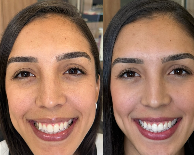 Antes e depois — procedimento 11