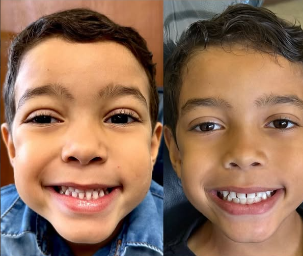 Antes e depois — procedimento 12