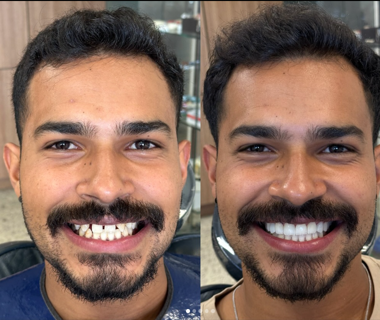 Antes e depois — procedimento 13