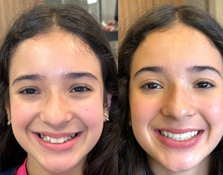 Antes e depois — procedimento 14