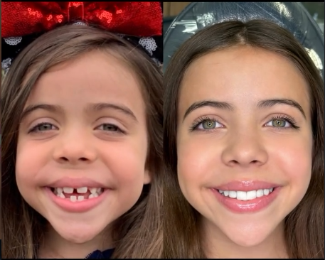Antes e depois — procedimento 1