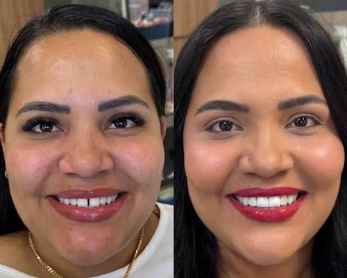 Antes e depois — procedimento 2