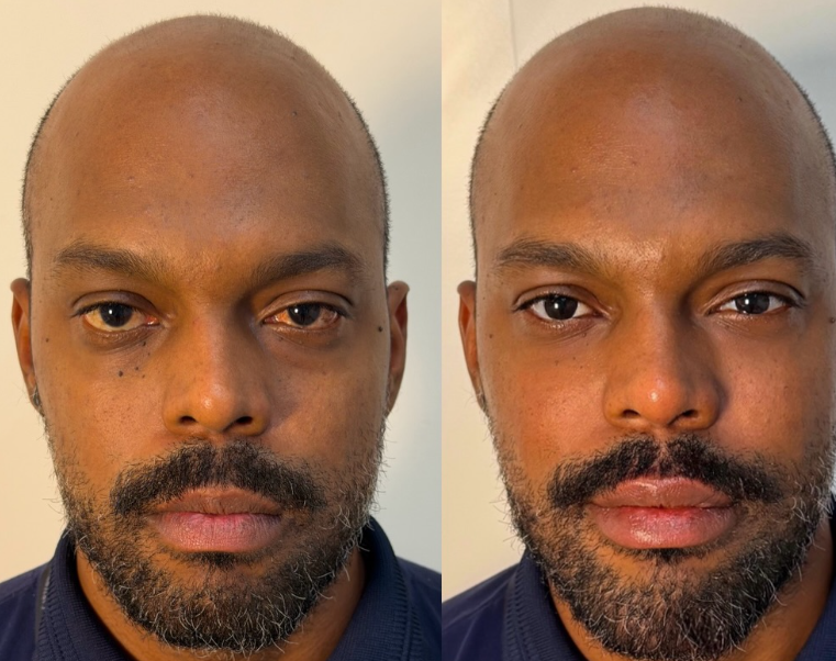 Antes e depois — procedimento 3