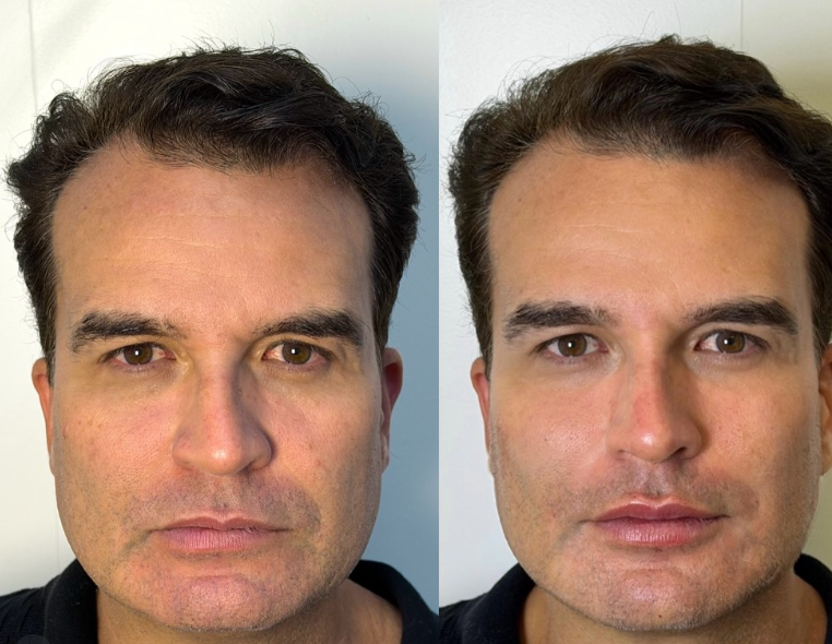 Antes e depois — procedimento 4