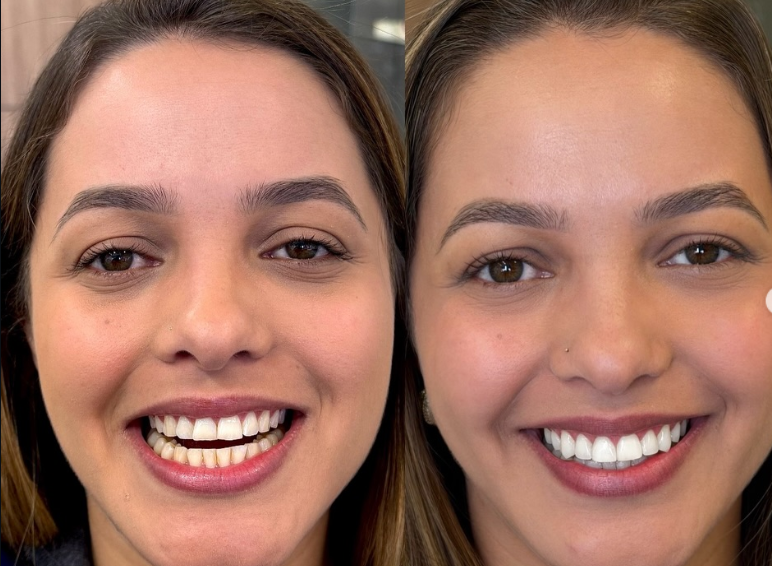 Antes e depois — procedimento 5