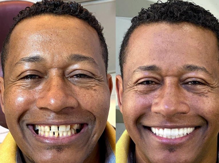 Antes e depois — procedimento 6