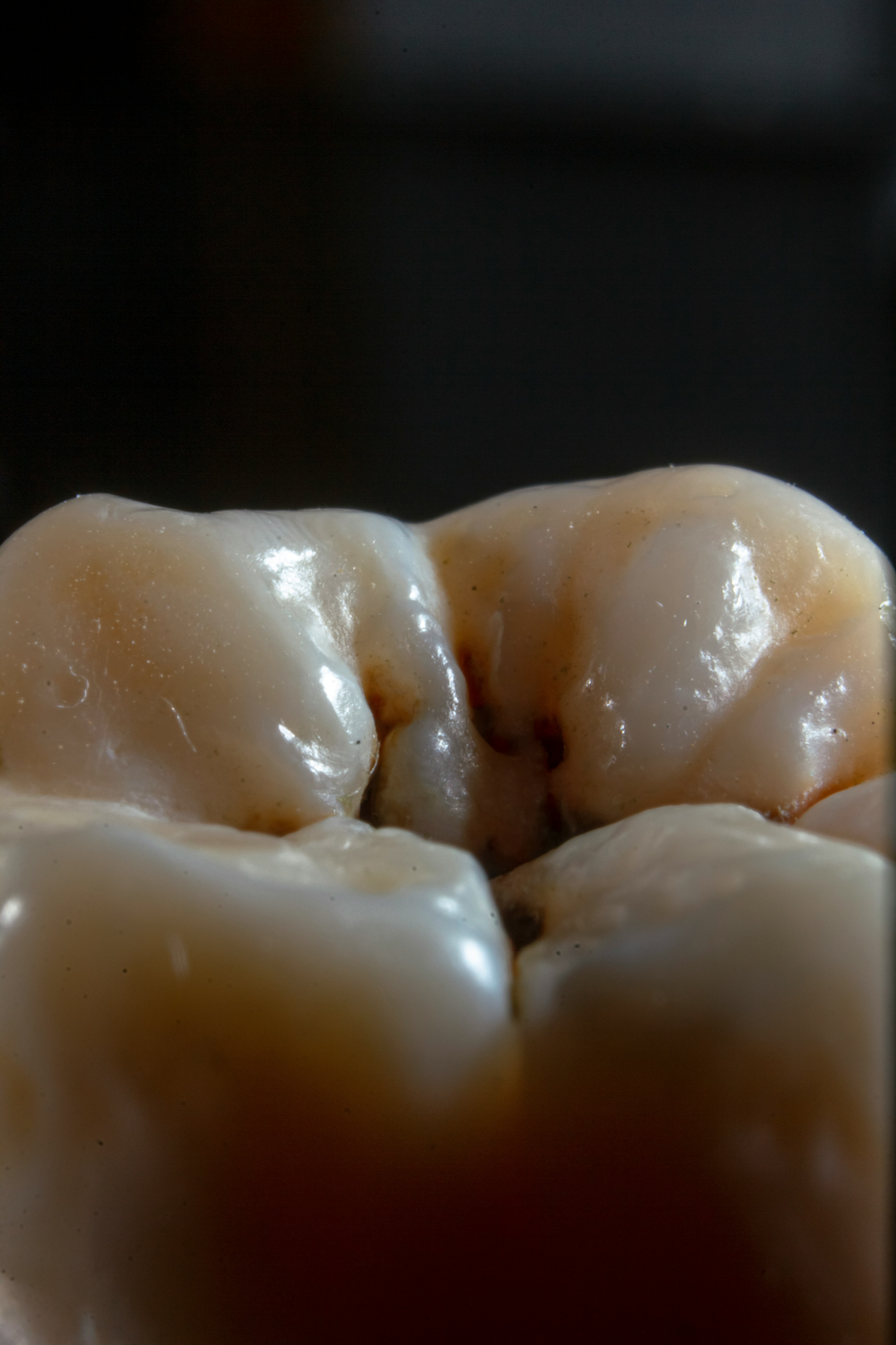 Cirurgia de dentes sisos